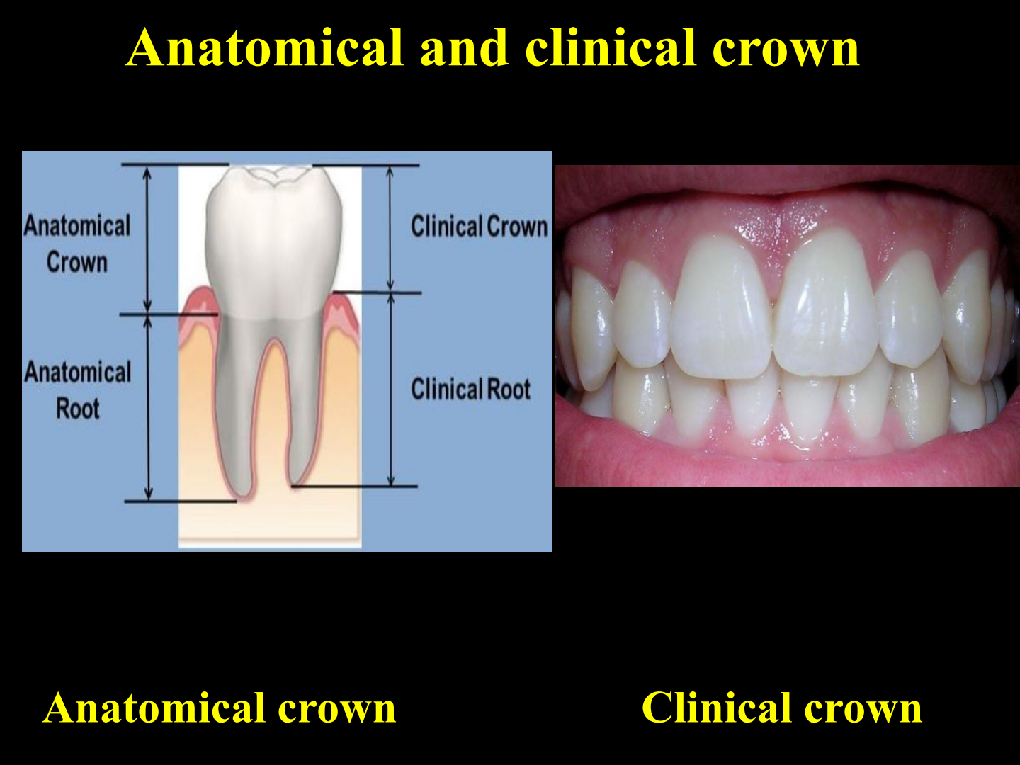 Anatomical and Clinical Crown Comparison