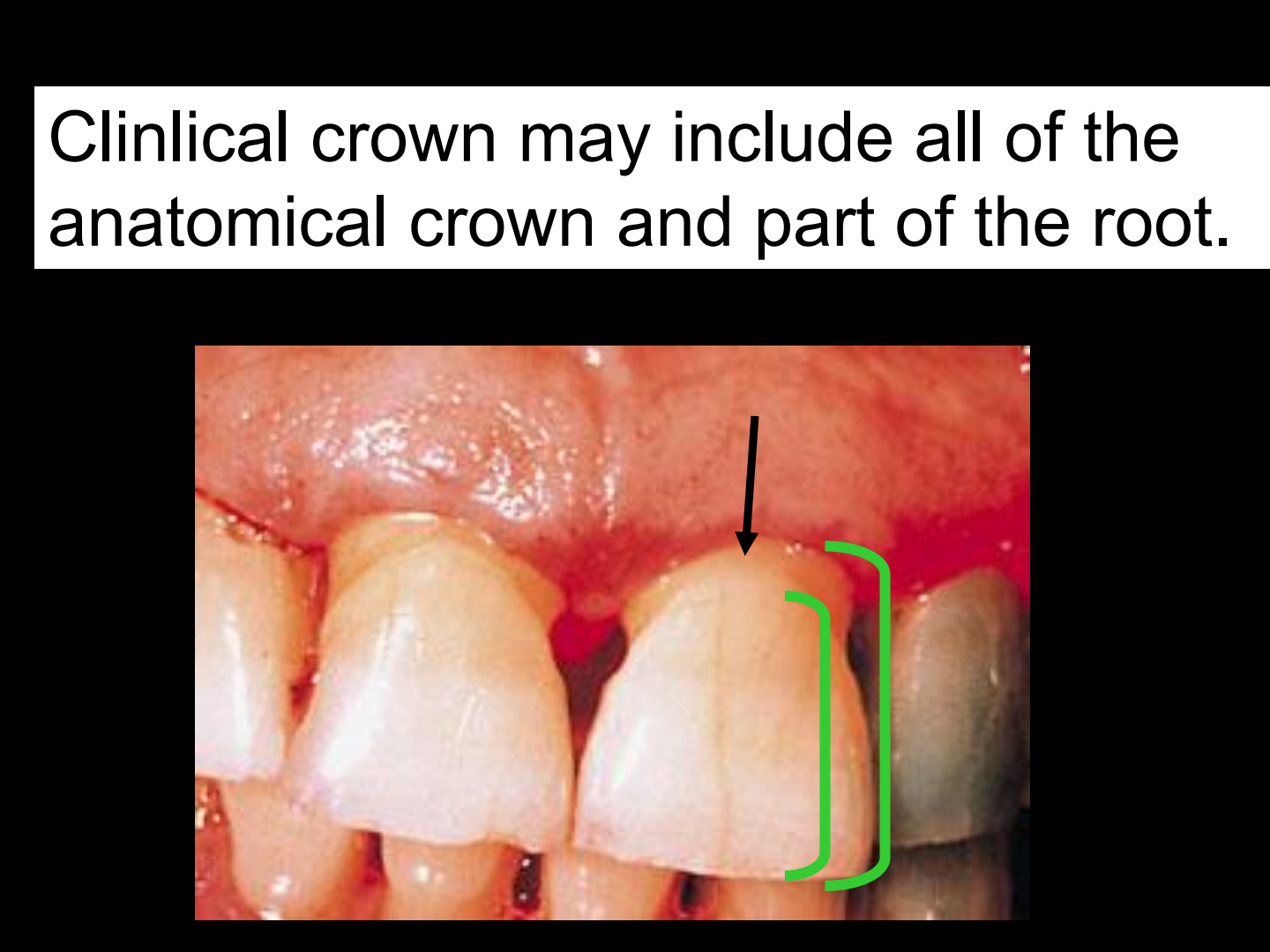 Clinical Crown including root