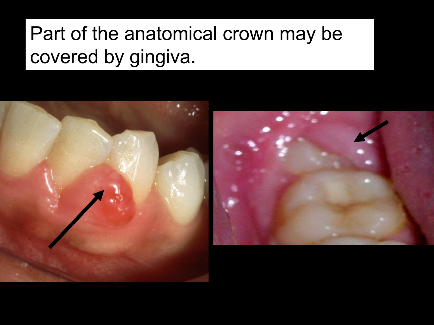 Gingiva covering anatomical crown