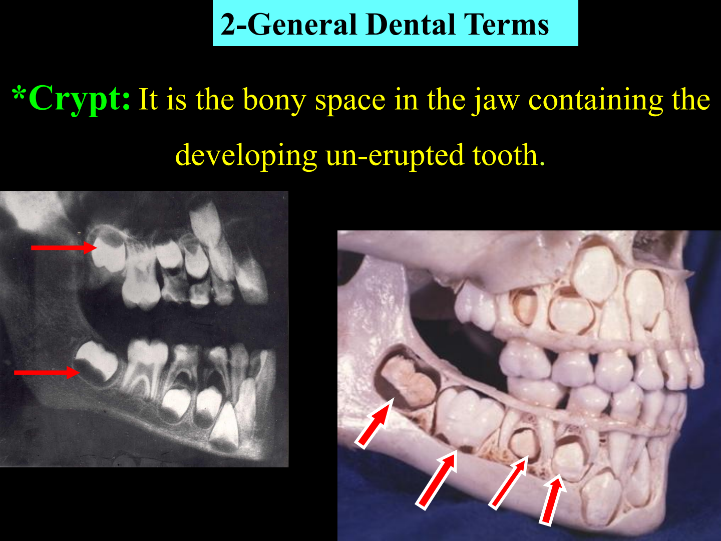 Bony Crypt with developing tooth