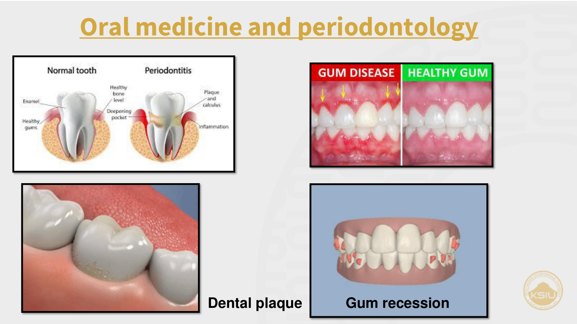Periodontology & Gum Recession