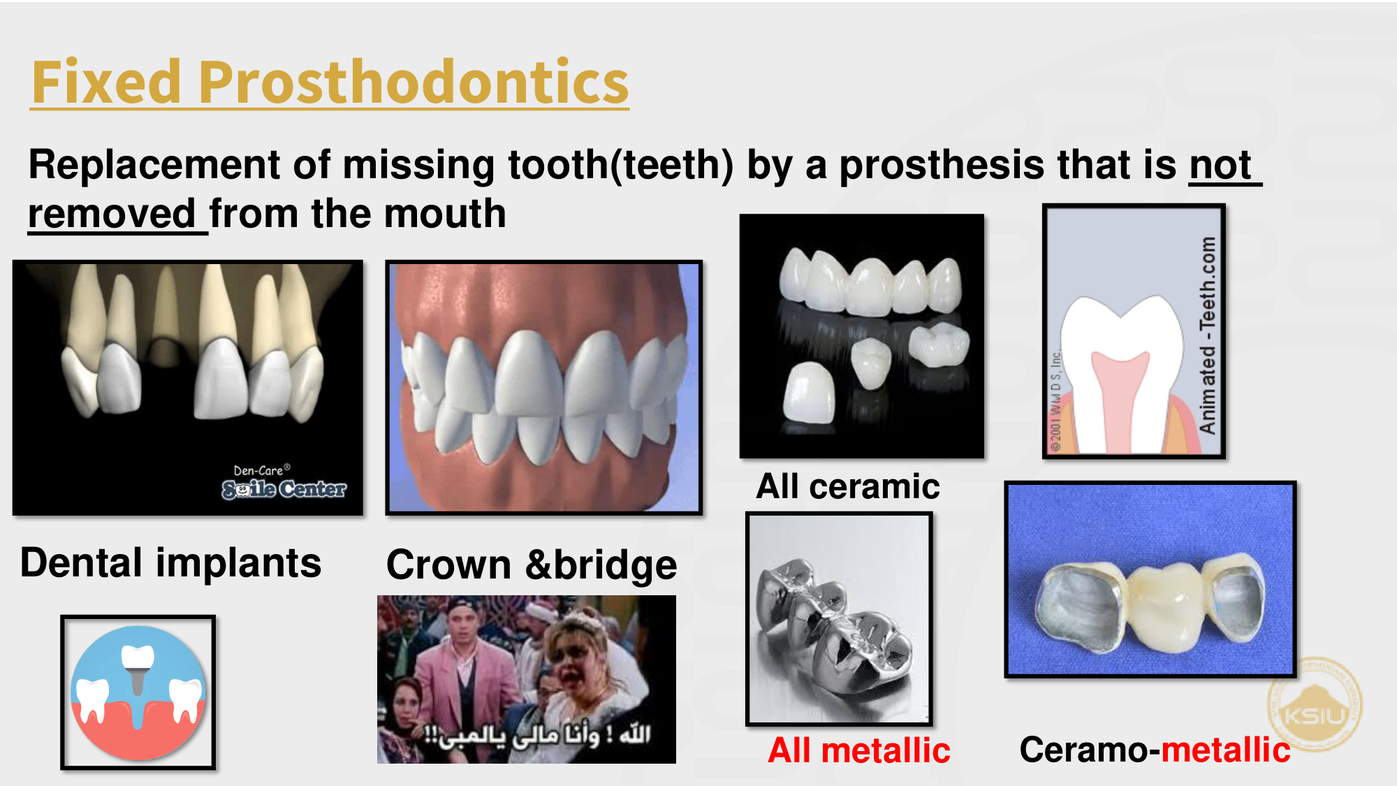 Fixed Prosthodontics Types