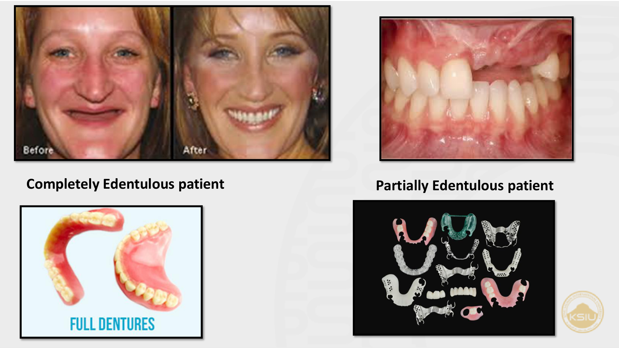 Completely vs Partially Edentulous