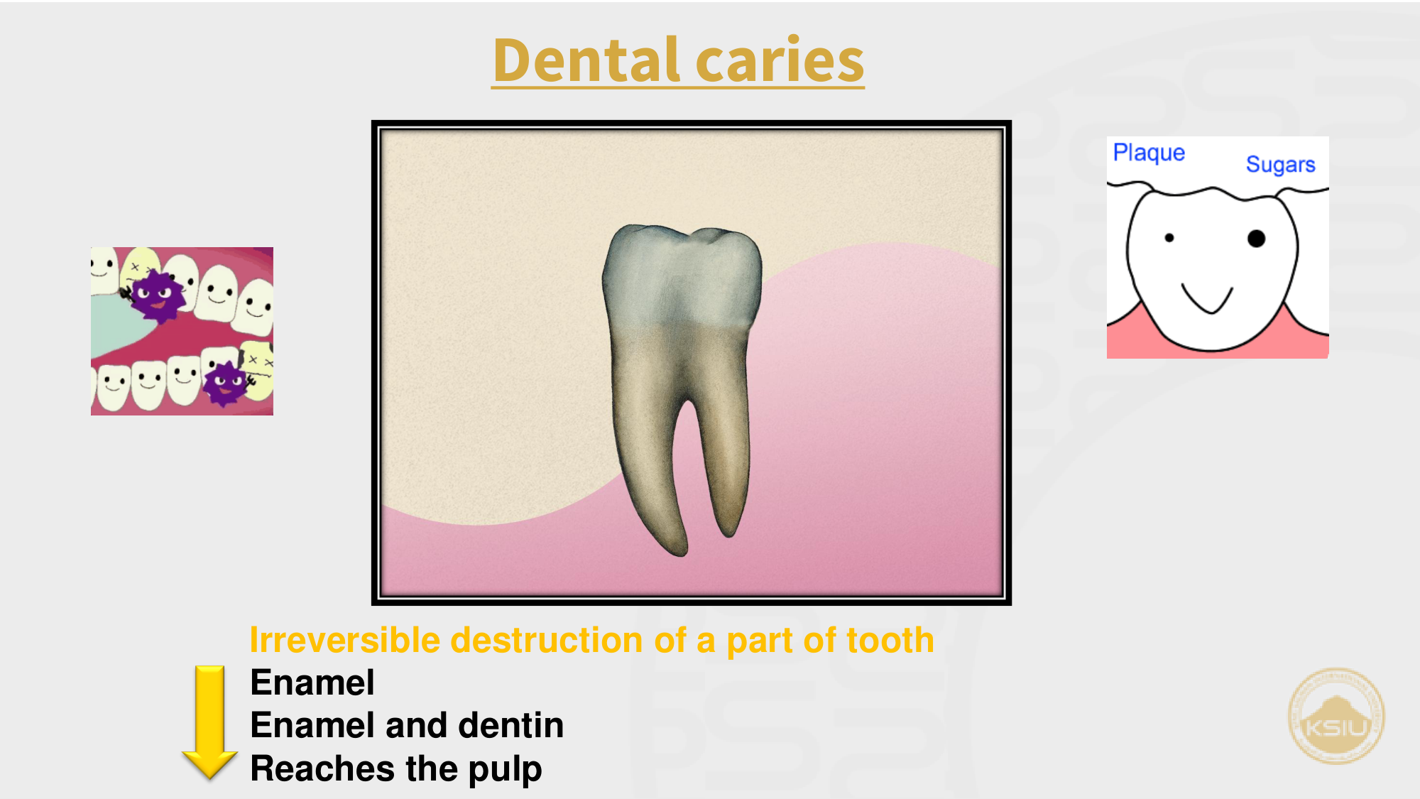 Dental Caries Progression