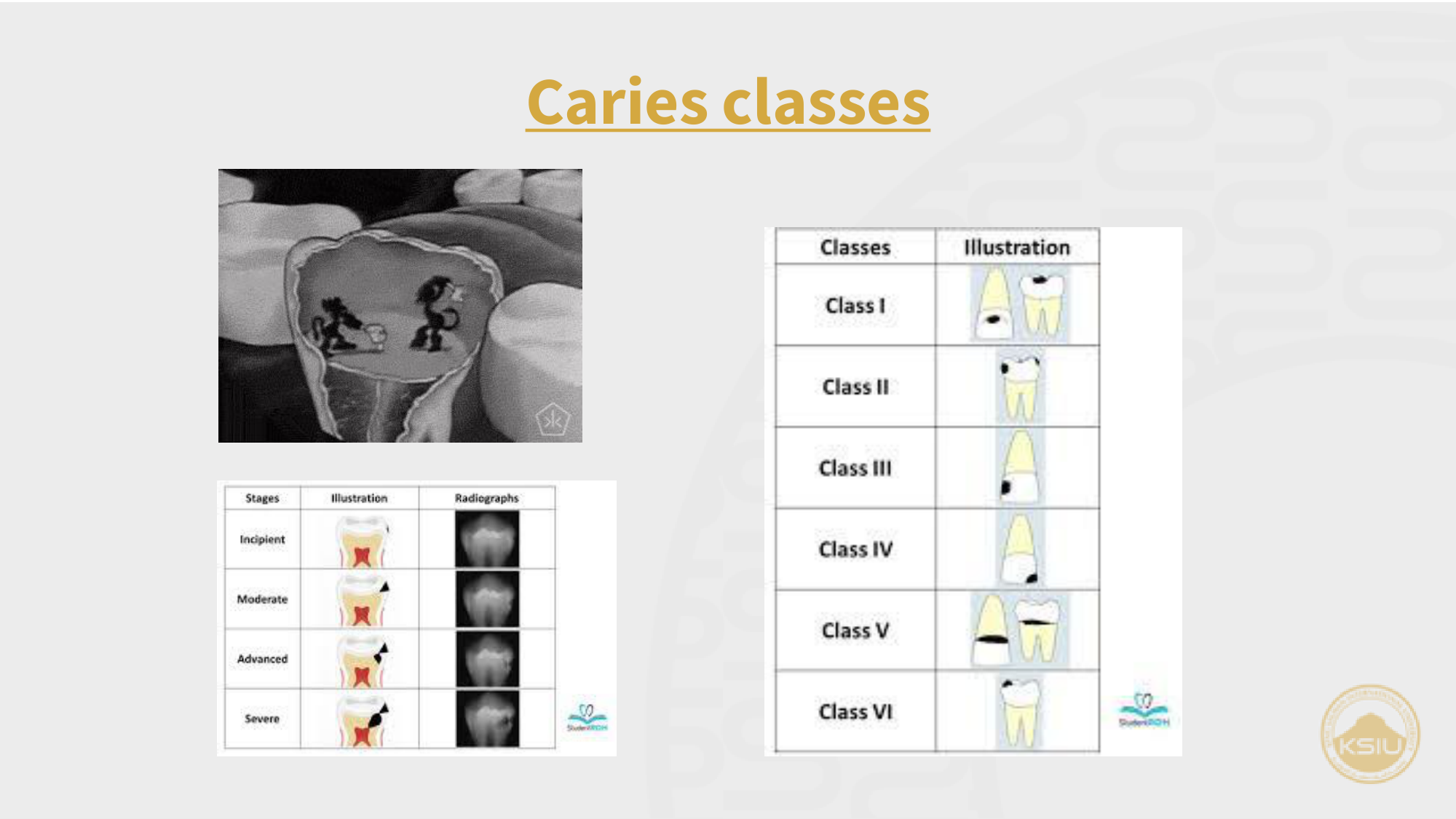 G.V. Black Caries Classes Table