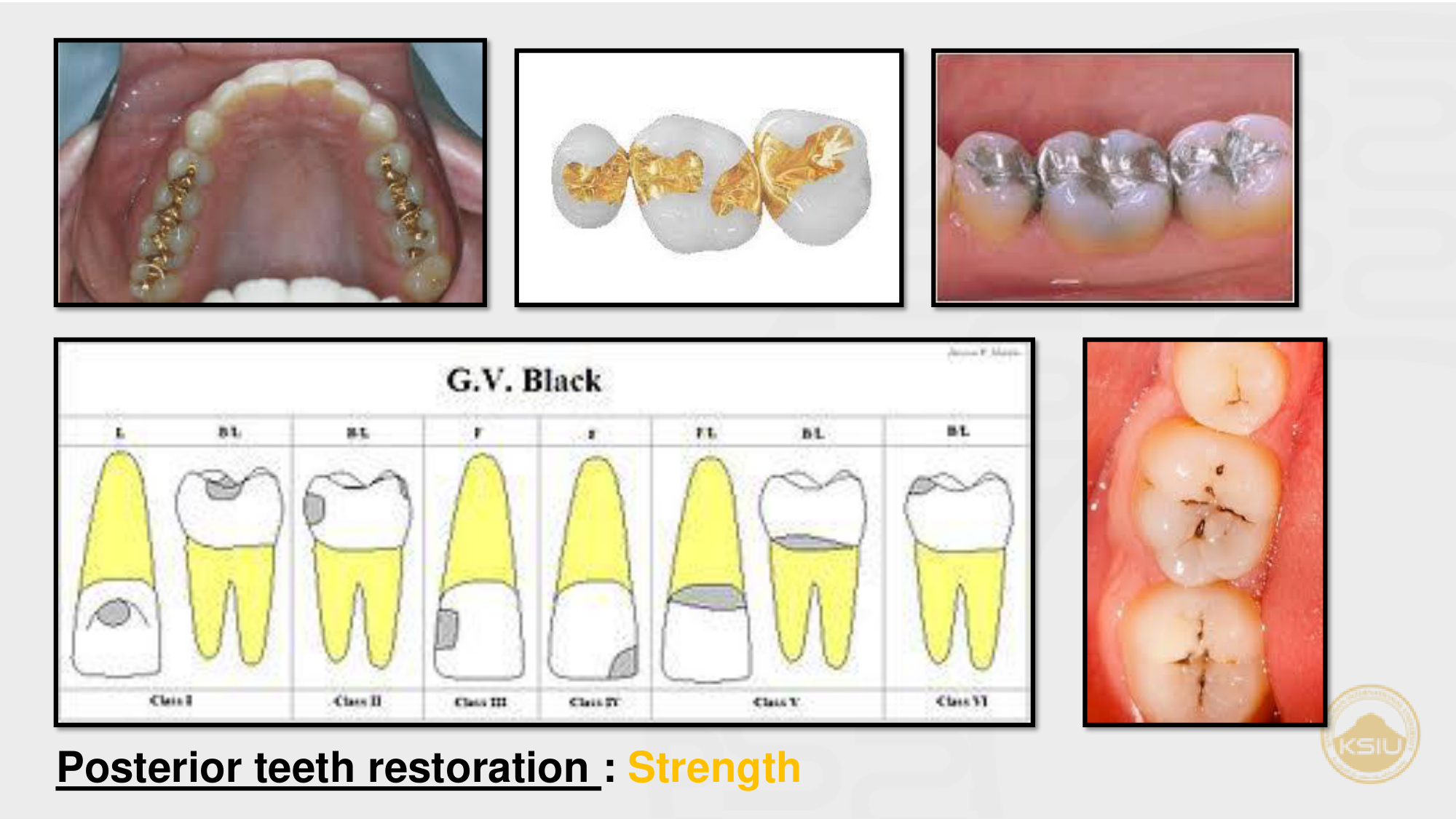 Posterior teeth restoration: Strength