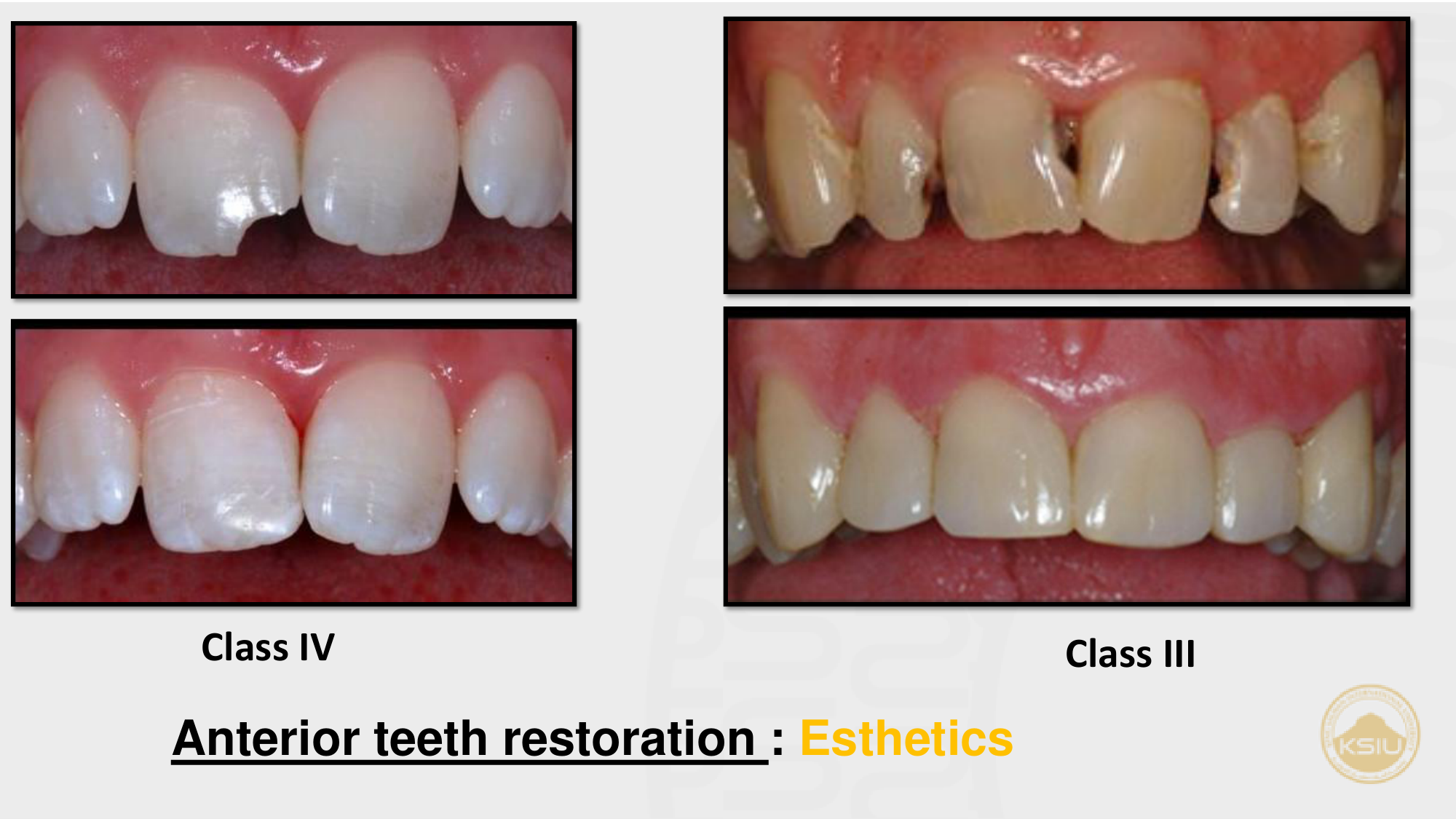 Anterior teeth restoration: Esthetics