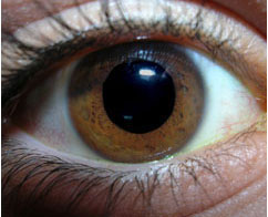 Pupil - Mydriasis